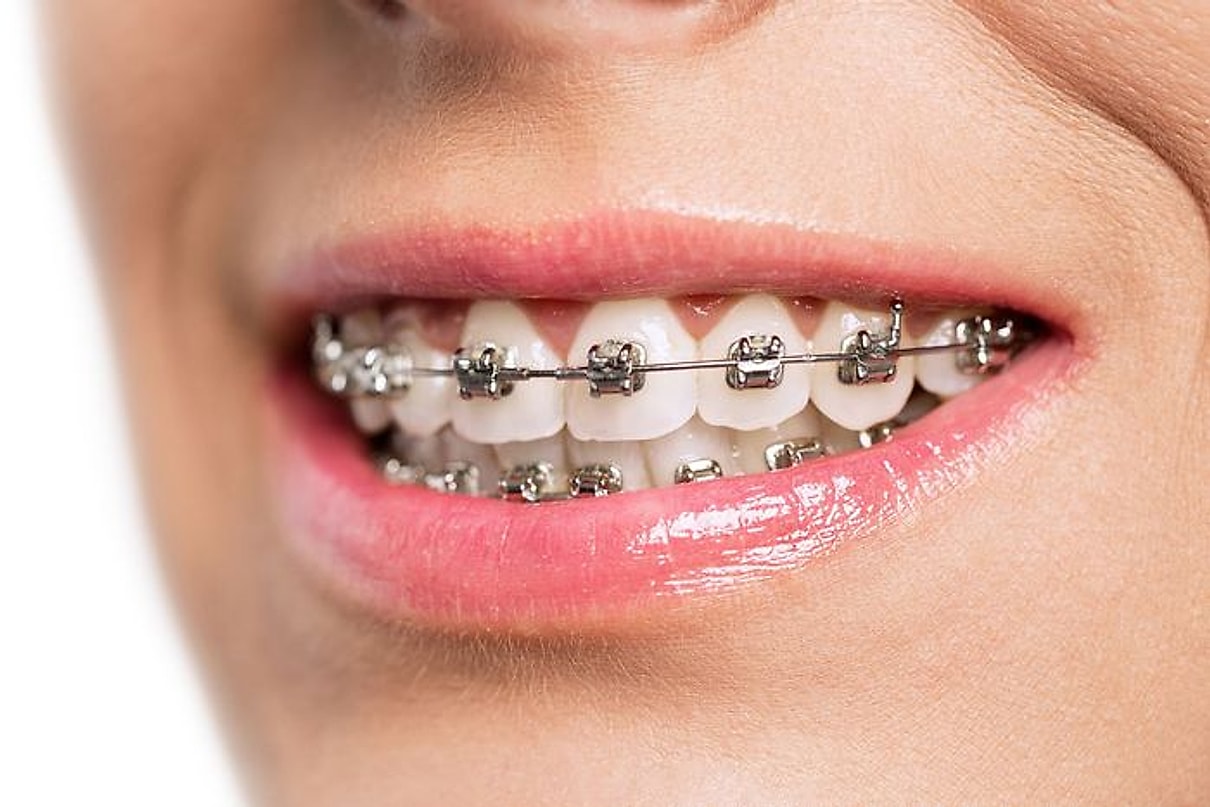 Sorriso con apparecchio ortodontico fisso
